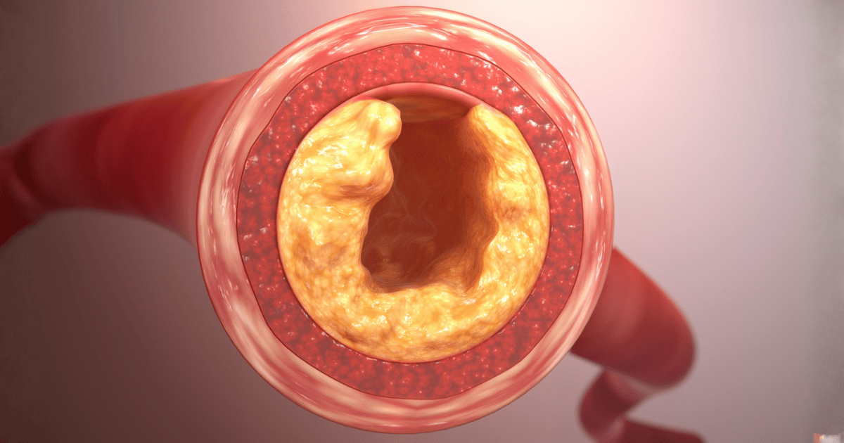 Aggiungi questi 5 cibi alla tua dieta per arterie più pulite e un flusso sanguigno migliore.